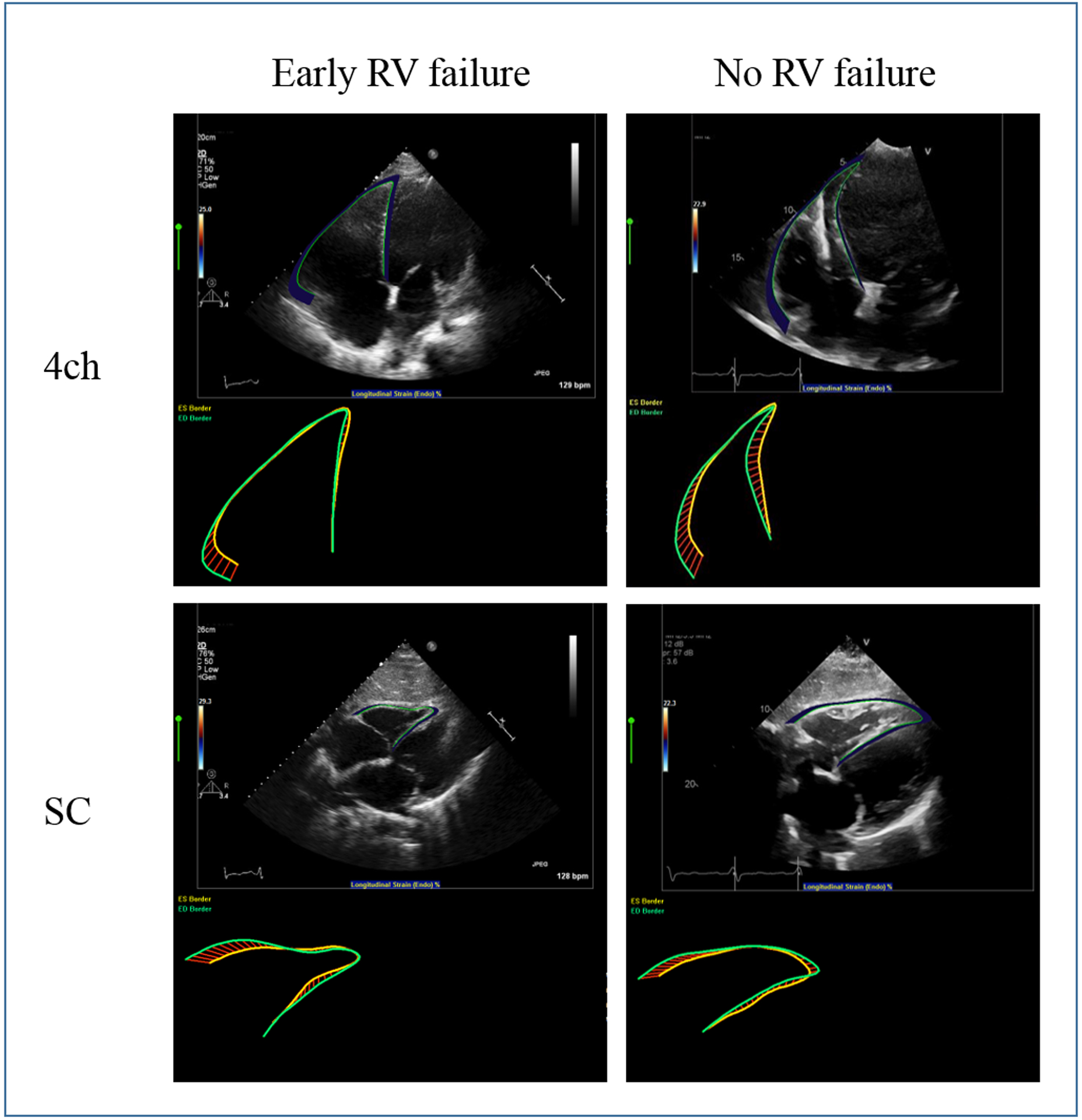 Right Ventricular Global Longitudinal Strain As A Predictor Of Acute 