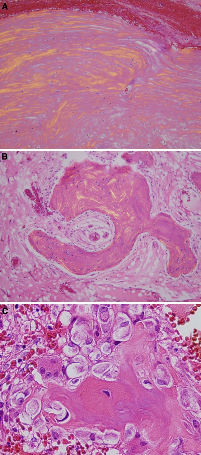 Frontal Sinus Osteoma with Osteoblastoma-like Histology and Associated ...