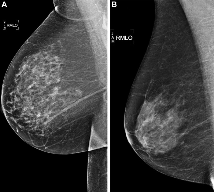 Right medial lateral oblique (RMLO) screening mammograms show negative results from 2016 in (A) a 73-year-old woman with Mirai artificial intelligence (AI) risk score with more than 90th percentile risk who developed right breast cancer in 2021 at 5 years of follow-up and (B) a 73-year-old woman with Mirai AI risk score with less than 10th percentile risk who did not develop cancer at 5 years after 5 years of follow-up.