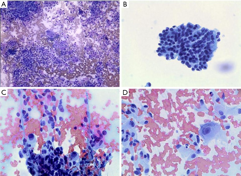 Functioning gangliocytic paraganglioma of the ampulla ...