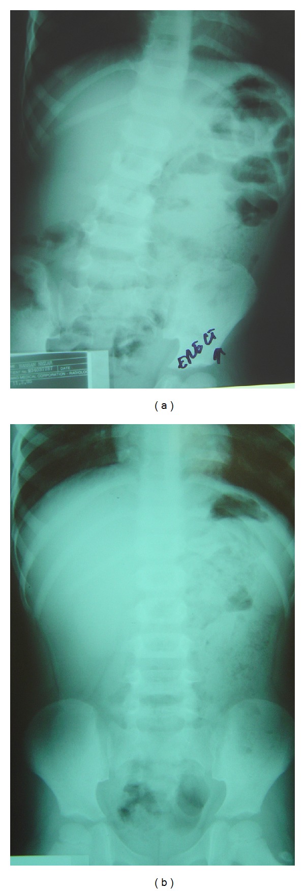 Small Bowel Cocoon: A Distinct Disease with a New Developmental ...