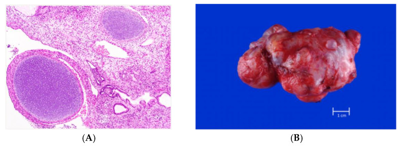 Fetal Teratomas: Advances in Diagnosis and Management - PMC