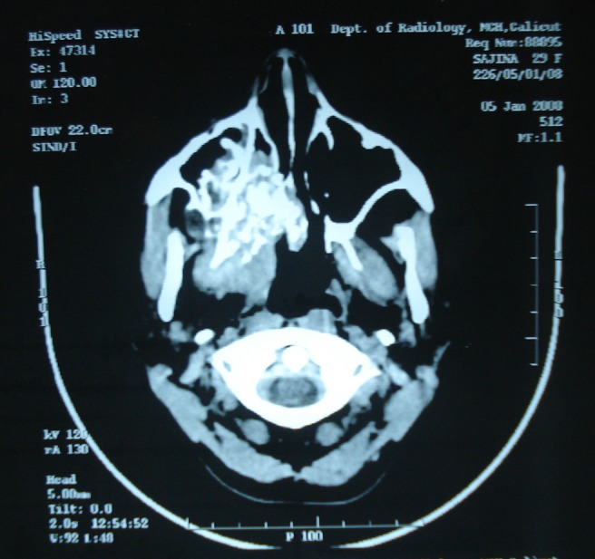 Central Mucoepidermoid Carcinoma Of Maxilla With Radiographic 