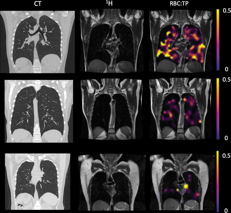 Example CT, proton (1H), and proton and red blood cell-to-tissue plasma (RBC:TP) images in participants with post-COVID-19 condition. Top row: Images in a participant with an RBC:TP value of 0.49. Middle row: Images in a participant with an RBC:TP value of 0.31. Bottom row: Images in a participant with an RBC:TP value of 0.24. Imaging revealed little to no discernible damage on CT scans, yet highly heterogeneous and low RBC:TP values in the lungs of nonhospitalized participants with post-COVID-19 condition.