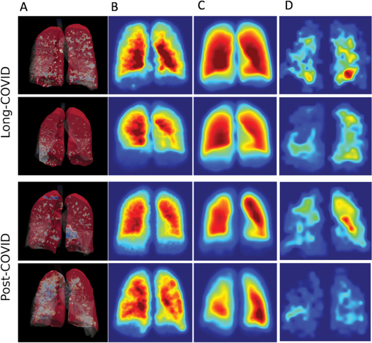 Three-dimensional rendering of (A) full-scale airway network (FAN), (B) FAN modeling, and (C, D) hyperpolarized xenon imaging in NHLC (C) and PHC (D) participants. Results from both low-resolution and ventilation imaging are similar and did not correlate with clinical or dissolved-phase imaging results.