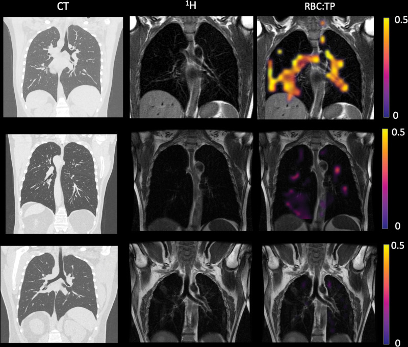 Example CT, proton (1H), and proton and red blood cell-to-tissue plasma (RBC:TP) images in posthospitalized participants with post-COVID-19 condition. Top row: Images in a participant with an RBC:TP value of 0.59. Middle row: Images in a participant with an RBC:TP value of 0.31. Bottom row: Images in a participant with an RBC:TP value of 0.16. Imaging revealed minimal damage on CT scans, yet highly heterogeneous and low RBC:TP values in the lungs of posthospitalized participants.