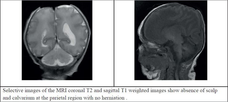 Aplasia Cutis Congenita Of The Scalp With Bone Defect And Exposed 