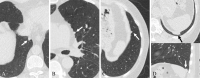 Example low-dose chest CT images of benign mediastinal or
diaphragmatic pleura–attached noncalcified nodules (NCNs) in
participants of the Initiative for Early Lung Cancer Research on
Treatment–Mount Sinai Health System cohort. (A) Axial low-dose CT
image in a 73-year-old male participant shows a mediastinal
pleura–attached NCN (arrow) with a smooth margin and triangular
shape. (B) Axial low-dose CT image in a 56-year-old female participant shows
a mediastinal pleura–attached NCN (arrow) with a smooth margin and
oval shape. (C) Axial low-dose CT image in a 64-year-old female participant
shows a diaphragmatic pleura–attached NCN (arrow) with a smooth
margin and triangular shape. (D) Axial (top) and sagittal (bottom) low-dose
CT images in a 65-year-old female participant show a diaphragmatic
pleura–attached NCN (arrow) with a smooth margin and semicircular
shape.