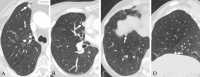 Example low-dose chest CT images of malignant mediastinal or
diaphragmatic pleura–attached noncalcified nodules (NCNs) in
participants of the Initiative for Early Lung Cancer Research on
Treatment–Mount Sinai Health System cohort. (A) Axial standard-dose
contrast-enhanced CT image in a 77-year-old female participant with
adenocarcinoma shows a mediastinal pleura–attached NCN lung cancer
(arrow) with a nonsmooth margin and round shape. (B) Axial low-dose CT image
in a 76-year-old female participant with typical carcinoid shows a
mediastinal pleura–attached NCN lung cancer (arrow) with a smooth
margin and round shape. (C) Axial and (D) sagittal low-dose CT images in a
59-year-old female participant with adenocarcinoma show a diaphragmatic
pleura–attached NCN lung cancer (arrow) with a smooth margin and
round shape.