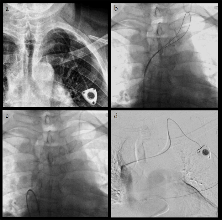 Long loop technique with bifemoral access as salvage technique for ...