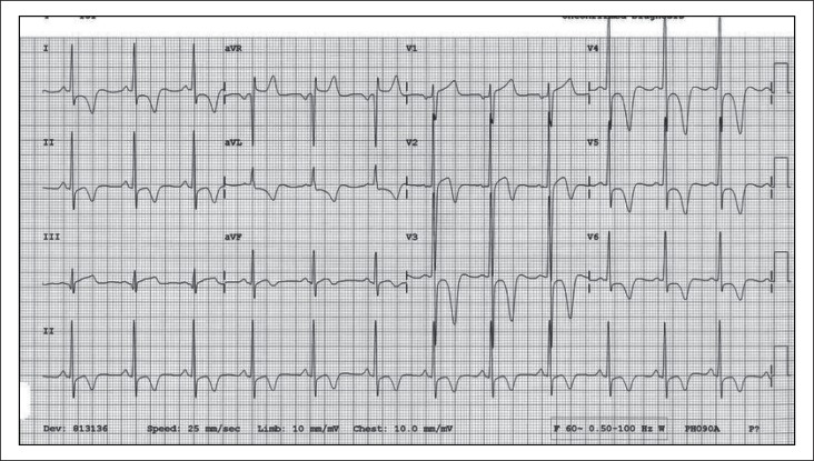 ECG Diagnosis: Apical Hypertrophic Cardiomyopathy - PMC