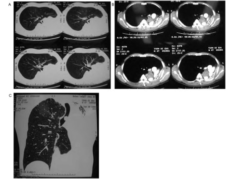 A：肺窗；B：纵隔窗；C：三维重建。 A: lung window; B: mediastinal window; C: three-dimensional reconstruction.