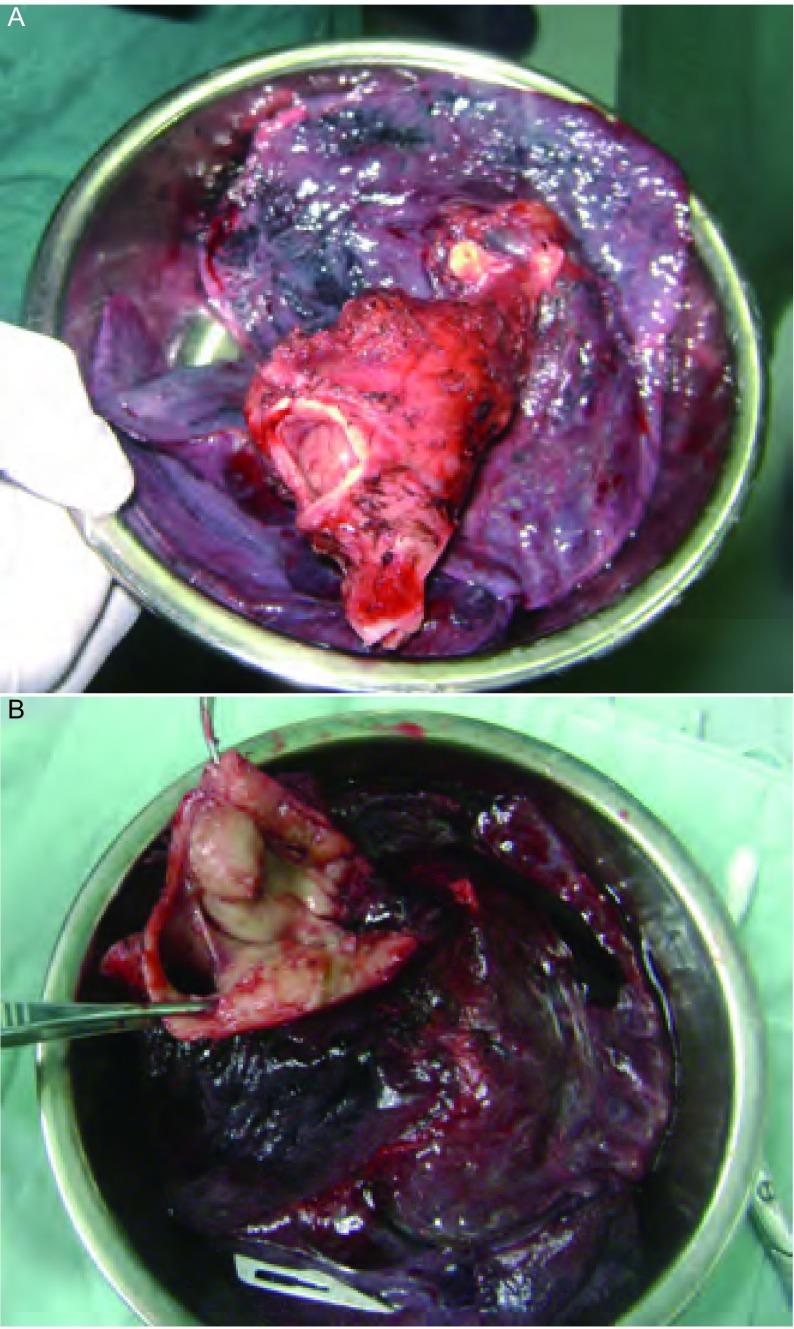 A：左主支气管未剖开；B：左主支气管剖开。 A: the left bronchea wasn't dissected; B: the left bronchea was dissected.