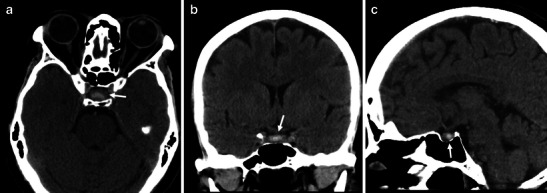 Pituitary apoplexy: an update on clinical and imaging features - PMC