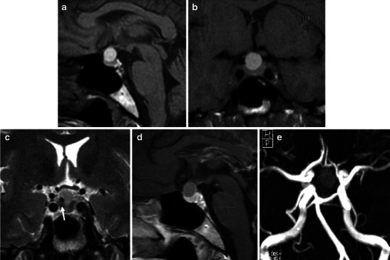 Pituitary apoplexy: an update on clinical and imaging features - PMC