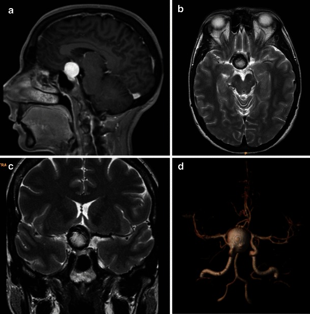 Pituitary apoplexy: an update on clinical and imaging features - PMC