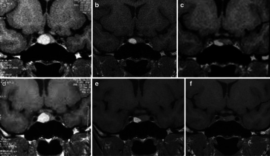 Pituitary apoplexy: an update on clinical and imaging features - PMC