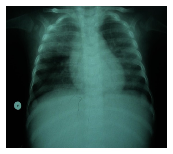 Congenital Pulmonary Alveolar Proteinosis - Pmc