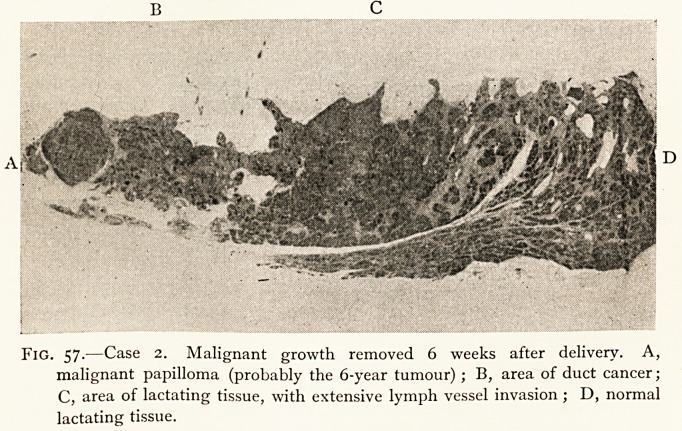 Fig. 57.—Case 2.