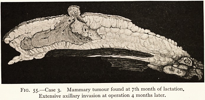 Fig. 55.—Case 3.