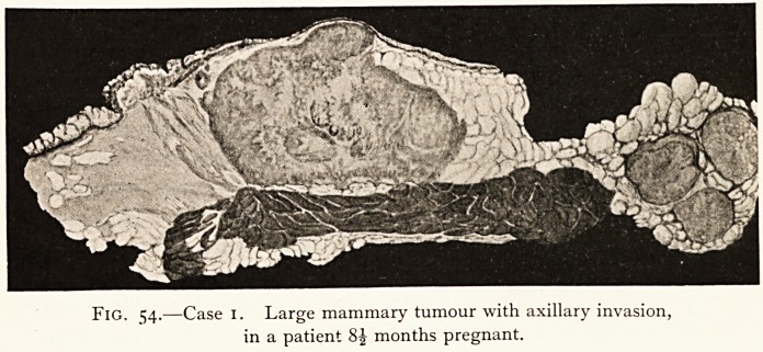 Fig. 54.—Case 1.