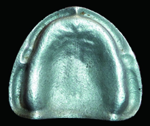 Figure 3: Metallic Edentulous Mould.