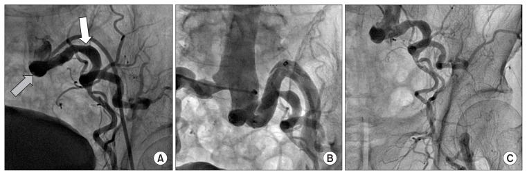 Aorto-Uni-Iliac Stent Grafting and Femoro-Femoral Bypass in a Patient ...