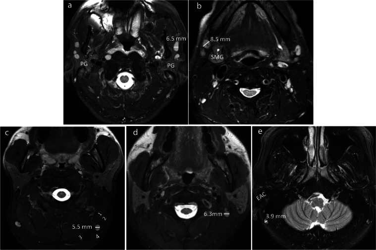 Normal size of benign upper neck nodes on MRI: parotid, submandibular ...