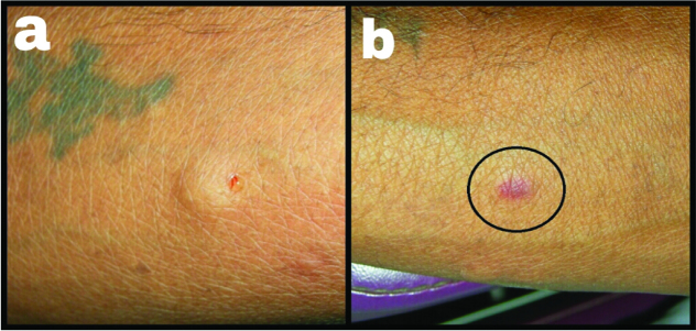 An Unusual Complication with Use of Lignocaine: A Case Report - PMC