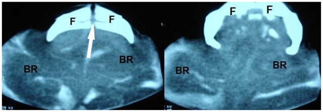 Fetal Acrania - Prenatal Sonographic Diagnosis and Imaging Features of ...