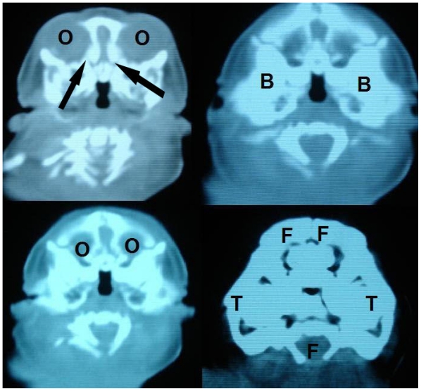 Fetal Acrania - Prenatal Sonographic Diagnosis and Imaging Features of ...