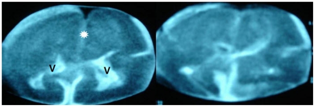 Fetal Acrania - Prenatal Sonographic Diagnosis and Imaging Features of ...