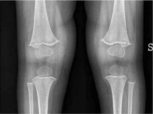 A good growth in a child with scurvy - PMC