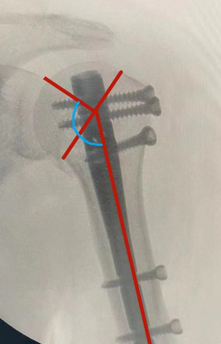 Intramedullary Nail for Treatment of Proximal Humeral Fracture: A ...