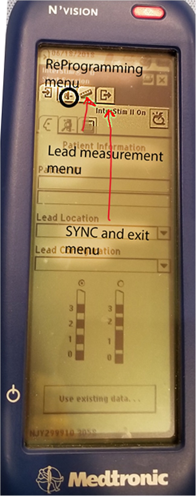 Troubleshooting Interstim Sacral Neuromodulation Generators To Recover Function Pmc