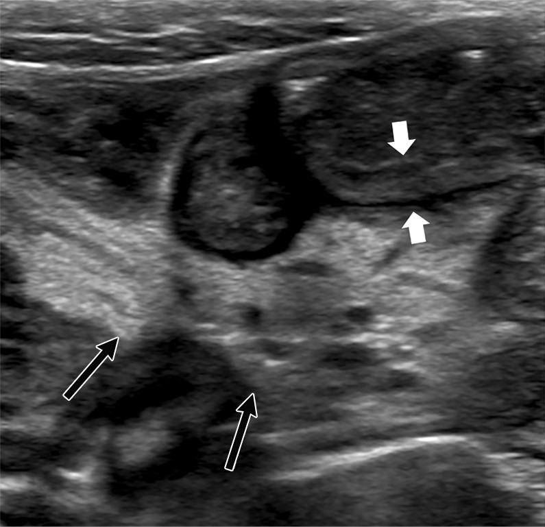 US features of right iliac fossa inflammation in four children. (a) High-frequency sonographic image in 7-year-old boy with multisystem inflammatory syndrome in children (MIS-C) and abdominal pain. Image depicts an enlarged mesenteric lymph node within the right iliac fossa (arrow), with associated hyperechoic mesenteric fat. The appendix is normal in diameter (arrowhead). (b) US scan in a 15-year-old boy with MIS-C. There are multiple mesenteric lymph nodes within the right iliac fossa, and the short-axis diameter of the largest lymph node was 13 mm (calipers). Image also shows associated hyperechoic mesenteric fat (arrow). (c) US scan in 9-year-old boy with MIS-C. Image shows loops of thickened small bowel (between white arrows) with associated hyperechoic mesenteric fat (black arrows). (d) High-frequency US scan in a 16-year-old boy with severe right iliac fossa pain shows marked cecal wall thickening (arrows).
