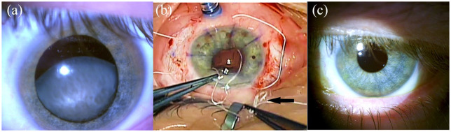 Marfan syndrome and the eye clinic: from diagnosis to management - PMC