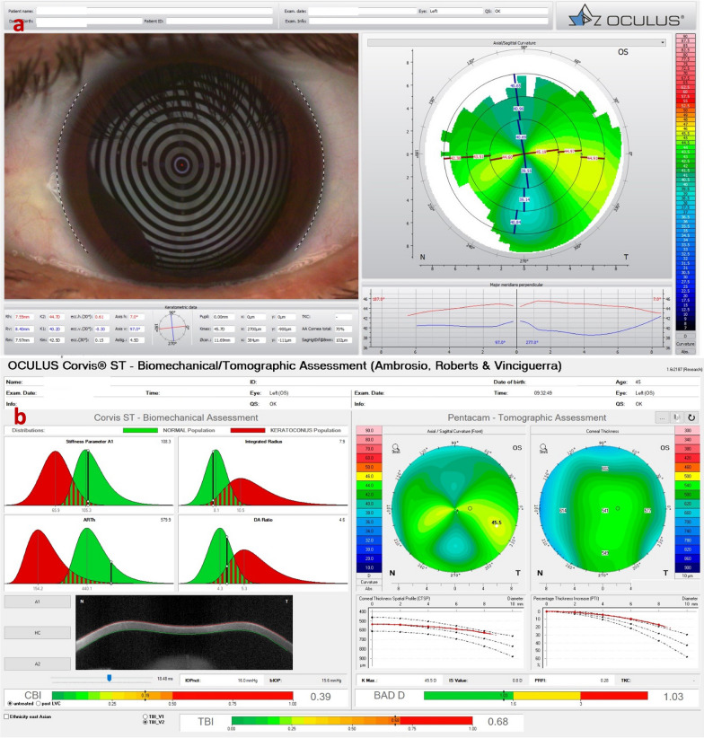 Multimodal Diagnostics For Keratoconus And Ectatic Corneal Diseases: A ...