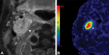 (A) Axial contrast-enhanced T1-weighted MR image demonstrates vagal
paraganglioma (arrowhead) with splaying of internal carotid artery and
internal jugular vein. (B) Corresponding increased blood flow of the vagal
paraganglioma (arrowhead) on arterial spin labeling perfusion.