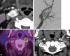 Multifocal head and neck paragangliomas. Right carotid body
paraganglioma on (A) axial contrast-enhanced CT image and (B) digital
subtraction angiographic image, with splaying of the internal (arrowhead)
and external (arrow) carotid arteries in the shape of a lyre. (C) Image from
gallium 68 tetraazacyclododecane tetraacetic acid octreotate (DOTATATE)
PET/CT following resection shows second initially missed left paraganglioma
vagale with high DOTATATE avidity (red). (D) Axial contrast-enhanced CT
image, in retrospect, helps confirm left paraganglioma vagale
(arrow).