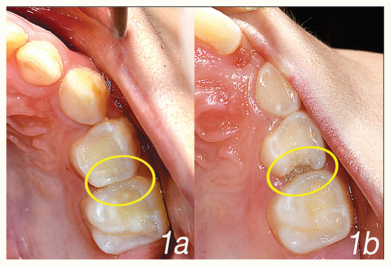 OXIS Contacts as a Risk Factor for Approximal Caries: A Retrospective ...