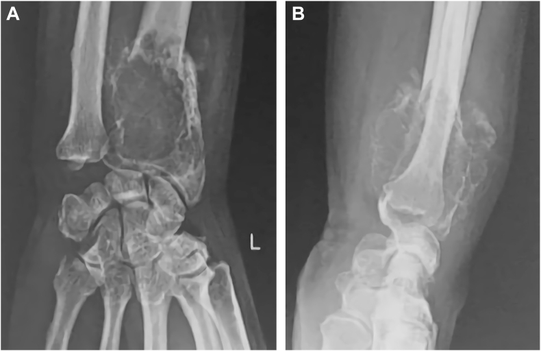 Diagnosis Of Bone Giant Cell Tumor In Elderly Patient: A Case Report Of 