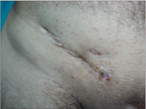 Seroma After Inguinal Hernia Repair With Mesh Outcome of the patients with chronic mesh infection following open