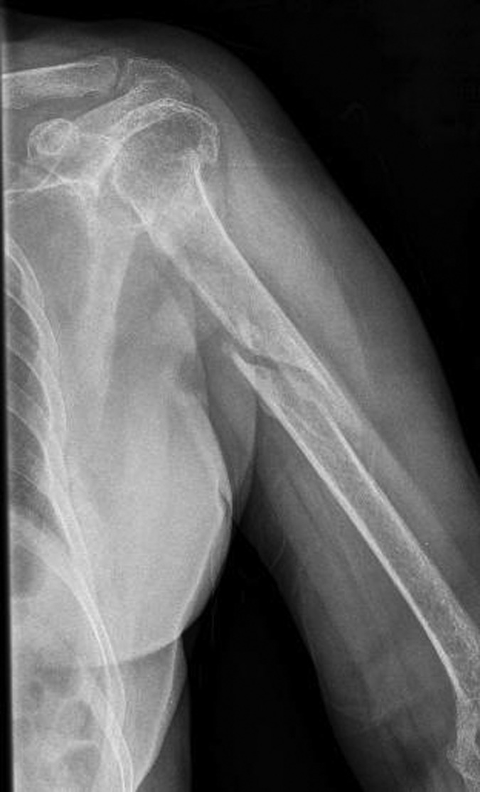 MIDSHAFT HUMERAL FRACTURE FOLLOWING A PROXIMAL HUMERAL FRACTURE: A CASE ...