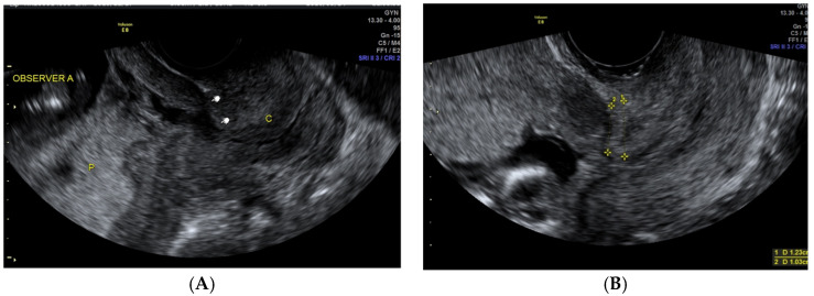 Caesarean Section Scar And Placental Location At The First Trimester Of 