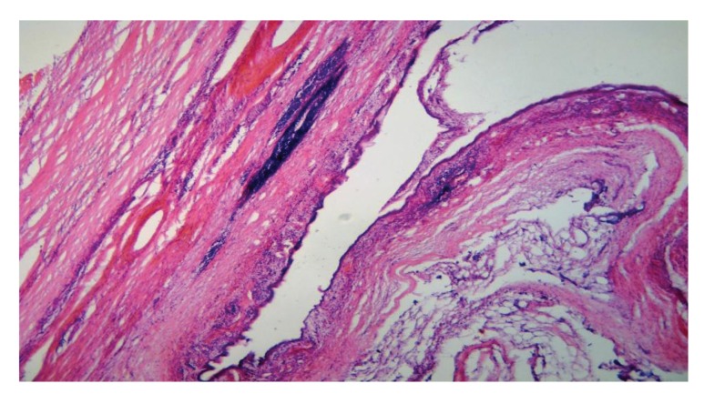 Serous Microcystic Adenoma of the Pancreas - PMC