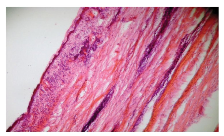 Serous Microcystic Adenoma of the Pancreas - PMC