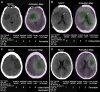 Axial noncontrast-enhanced CT (NCCT) images (left side of each panel)
and corresponding saliency activation maps (right side of each panel)
generated by deep learning–based imaging models in four patients with
diverse clinical scenarios. Activations are color-coded: green shows higher
attention levels. Although the model predictions are continuous, they have
been rounded to the nearest integer for ease of comparison with the actual
modified Rankin Scale (mRS) scores. (A) Images in a 51-year-old female
patient with a history of atrial fibrillation and a 90-day mRS score
(patient A). Both the clinical and imaging models accurately predicted the
score of 2, with increased attention focused on the lesion area. (B) Images
in a 69-year-old female patient with atrial fibrillation and hypertension
and a 90-day mRS score of 5 (patient B). The clinical and imaging models
produced differing and incorrect estimates (6 and 4, respectively), whereas
the fused model accurately predicted a score of 5. (C) Images in a
66-year-old male patient with no history of hypertension, atrial
fibrillation, or diabetes mellitus, with a 90-day mRS score of 6 (deceased;
patient C). The clinical model underestimated the score as 4, whereas the
imaging and fused models predicted a score of 5, which was closer to the
actual 90-day mRS score. (D) Images in a 55-year-old female patient with no
history of hypertension, atrial fibrillation, or diabetes mellitus, with a
90-day mRS score of 2 (patient D). The clinical model underestimated her
score as 1, whereas both the imaging and fused models accurately predicted a
score of 2, which matched her 90-day mRS score. AF = atrial fibrillation, BL
= baseline, DM = diabetes mellitus, HTN = hypertension, NIHSS = National
Institutes of Health Stroke Scale score, 24-hour NIHSS = baseline-adjusted
24-hour NIHSS score.