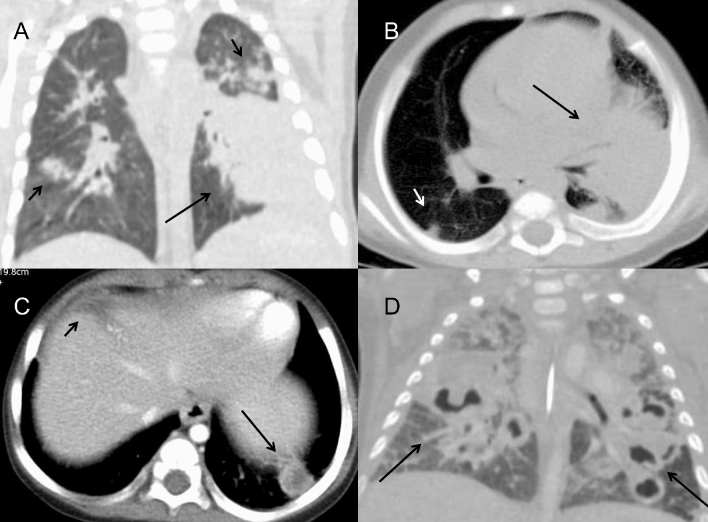 Imaging Findings Of Pulmonary Manifestations Of Chronic Granulomatous 