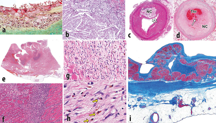 Pathophysiology of atherosclerotic plaque and MI. (a) Photomicrograph shows the surface of intimal plaque, with a luminal layer of foamy macrophages. The proteoglycan-rich fibrous portion of the plaque is depicted below (green area) (Movat pentachrome stain). (b) Photomicrograph shows the incipient necrotic core with foam cell macrophages (top right) that are degenerated with the release of free cholesterol from cell membranes forming crystals (bottom left). (c) Photomicrograph shows a fully developed necrotic core (NC), with thinning of the fibrous cap (arrows). (d) Photomicrograph shows an occlusive thrombus (Thr) within the arterial lumen, with a disrupted fibrous cap (arrow) overlying the necrotic core (NC). (e) Photomicrograph shows acute MI, transmural, with rupture. The rupture track is toward the left. The dark blue areas are degenerative neutrophils. (f) Photomicrograph shows a higher magnification of the blue areas in e that are fragmenting neutrophils. (g) Photomicrograph shows a healing infarct, with fibroblasts, early collagen strands, and abundant hemosiderin macrophages. (h) Photomicrograph shows hemosiderin macrophages (arrows) that were depicted at a lower resolution in g. (i) Photomicrograph shows a healed transmural infarct. This Masson trichrome stain demonstrates dense scar (blue area) from the endocardium (above) to the epicardium (below). There is some viable entrapped cardiac muscle near the endocardium (dark red area). Much of the fat near the epicardium is secondary to the infarct; fatty metaplasia is common in cardiac scars.